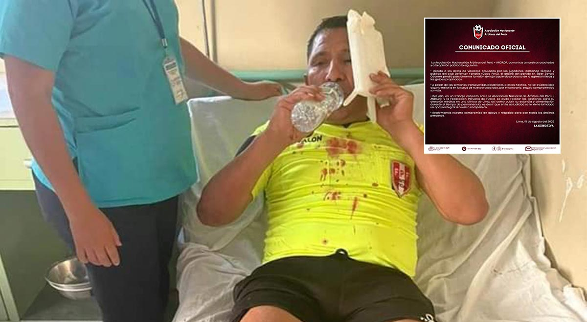 Árbitro agredido en partido de Copa Perú no presenta mejorías y sigue sin recuperar la vista