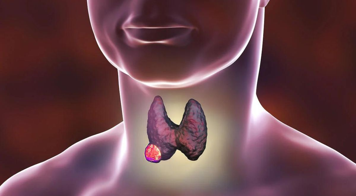 Día Mundial del Cáncer de Tiroides: ¿Cómo detectar esta enfermedad oportunamente?
