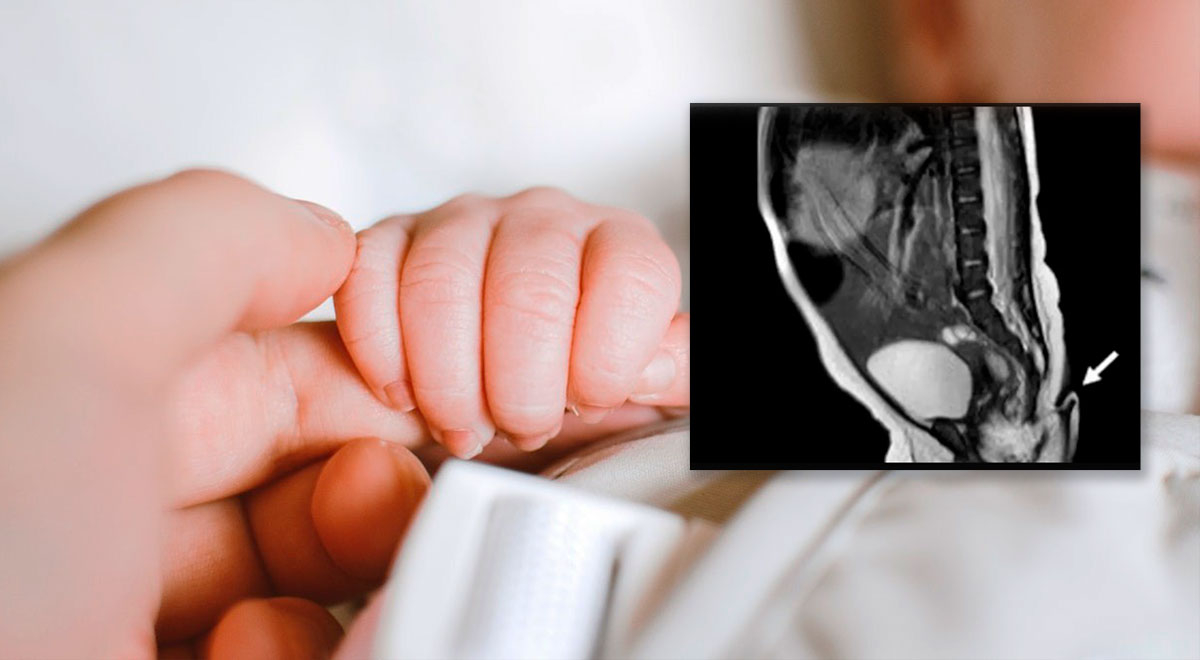 El increíble nacimiento de un bebé con una cola de 6 centímetros que impresionó al mundo