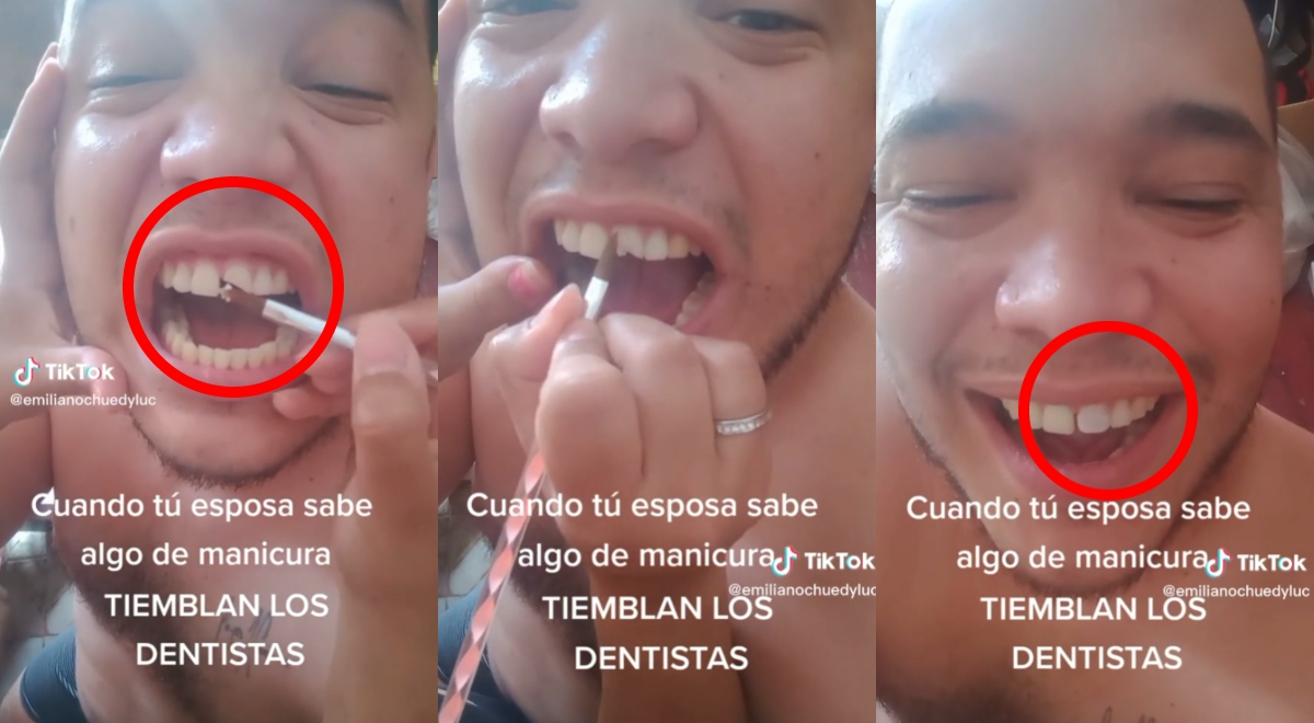 Mujer ‘cura’ con acrílico diente roto de su esposo y se vuelve viral: “Tiemblan los dentistas”