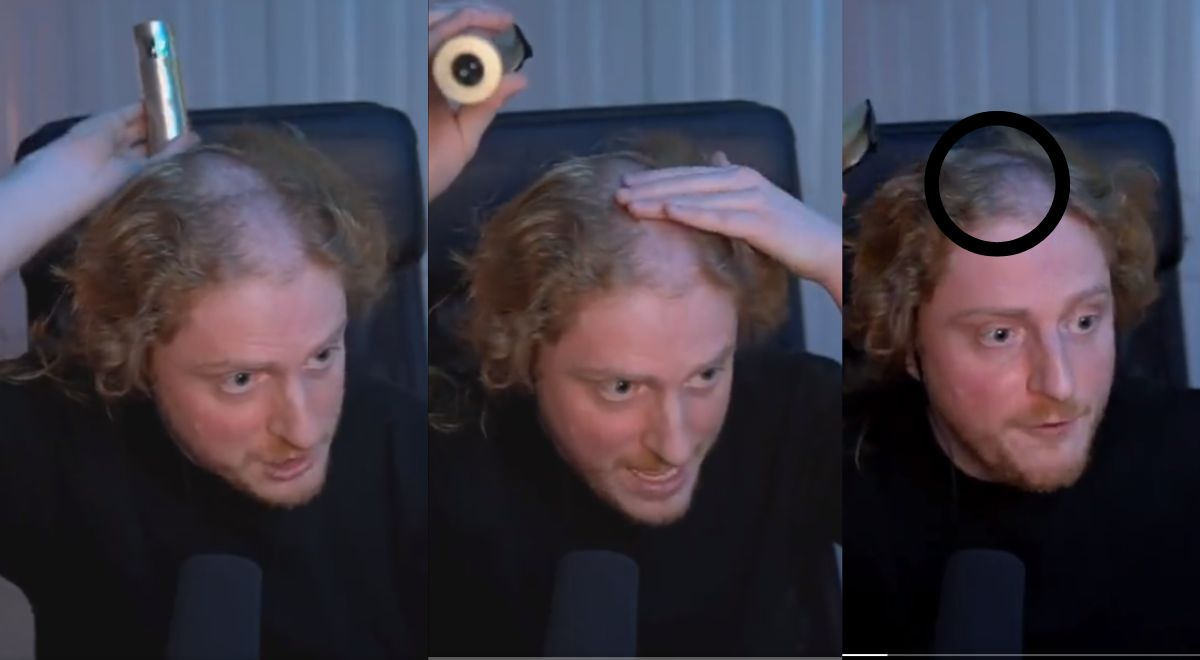 Streamer descubre un 'hoyo' en su cabeza por usar auriculares